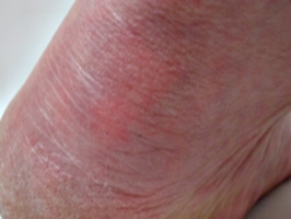 [picture: Close-up of a bare heel]