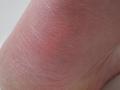 [Picture: Close-up of a bare heel]