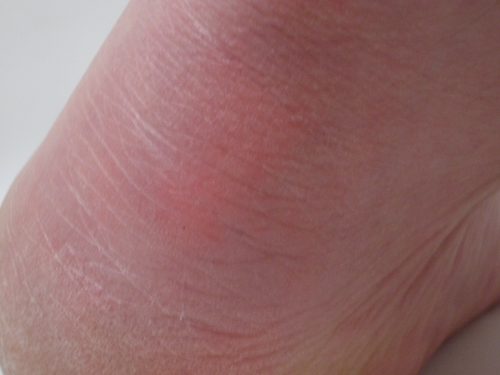 [Picture: Close-up of a bare heel]